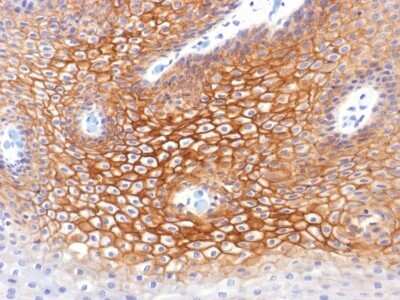 Immunohistochemistry-Paraffin: gamma Catenin Antibody (CTNG/1483) [NBP2-53165] - Formalin-fixed, paraffin-embedded human Cervical Carcinoma stained with Catenin, gamma Monoclonal Antibody (CTNG/1483)