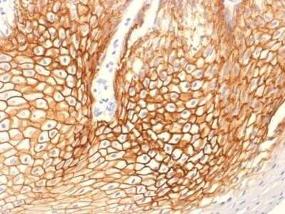 Immunohistochemistry-Paraffin: gamma Catenin Antibody (CTNG/1664) - Azide and BSA Free [NBP2-54524] - Formalin-fixed, paraffin-embedded human Cervical Carcinoma stained with Catenin, gamma Monoclonal Antibody (CTNG/1664)