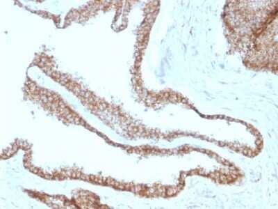 Immunohistochemistry-Paraffin: gamma Catenin Antibody (CTNG/1664) - Azide and BSA Free [NBP2-54524] - Formalin-fixed, paraffin-embedded human Prostate Carcinoma stained with Catenin, gamma Monoclonal Antibody (CTNG/1664)