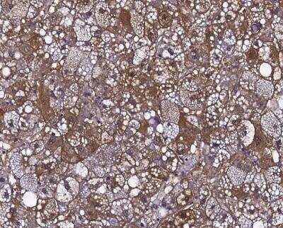 Immunohistochemistry-Paraffin: gamma-Glutamylcyclotransferase/CRF21/GGCT Antibody [NBP3-12540] - Staining of human GGCT in human hepatoma with rabbit polyclonal antibody (1:10000).