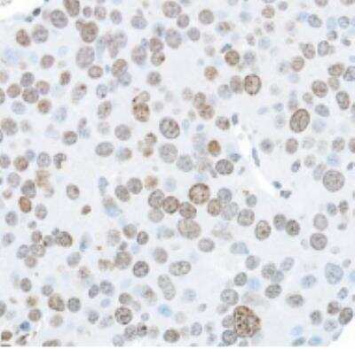 Immunohistochemistry-Paraffin: Histone H2AX Antibody (BLR053F) [NBP3-14678] - Section of mouse CT26 tumor. Antibody: Rabbit Histone H2AX antibody (BLR053F) used at 1:250. Secondary: HRP-conjugated goat anti-rabbit IgG. Substrate:DAB.