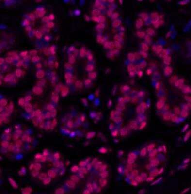 Immunohistochemistry-Paraffin: Histone H2AX Antibody (BLR053F) [NBP3-14678] - Section of human breast carcinoma. Antibody: Rabbit Histone H2AX antibody (BLR053F) used at 1:100. Secondary: DyLight(R) 594-conjugated goat anti-rabbit IgG. Counterstain: DAPI.