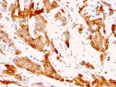 Immunohistochemistry-Paraffin: gp96/HSP90B1/GRP94 Antibody (9G10.F8.2) - IHC-Prediluted [NBP2-48046] - Formalin-fixed, paraffin-embedded human Breast Carcinoma stained with gp96/HSP90B1/GRP94 Antibody (9G10.F8.2).