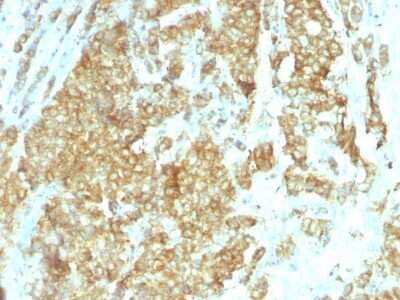 Immunohistochemistry-Paraffin: gp96/HSP90B1/GRP94 Antibody (HSP90B1/1192) [NBP2-44691] - Human Breast Carcinoma stained with GRP94 Monoclonal Antibody (HSP90B1/1192).