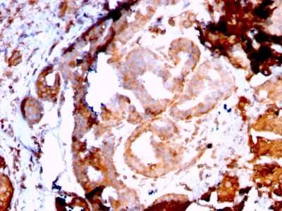 Immunohistochemistry-Paraffin: gp96/HSP90B1/GRP94 Antibody (HSP90B1/3168R) - Azide and BSA Free [NBP3-08763] - Formalin-fixed, paraffin-embedded human Breast Carcinoma stained with gp96/HSP90B1/GRP94 Recombinant Rabbit Monoclonal Antibody (HSP90B1/3168R).