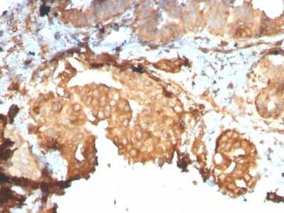 Immunohistochemistry-Paraffin: gp96/HSP90B1/GRP94 Antibody (HSP90B1/3168R) - Azide and BSA Free [NBP3-08763] - Formalin-fixed, paraffin-embedded human Breast Carcinoma stained with gp96/HSP90B1/GRP94 Recombinant Rabbit Monoclonal Antibody (HSP90B1/3168R).