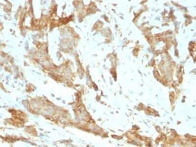 Immunohistochemistry-Paraffin: gp96/HSP90B1/GRP94 Antibody (SPM249) - IHC-Prediluted [NBP2-48051] - Human Breast Carcinoma stained with GRP94 Monoclonal Antibody (SPM249).