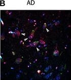 Immunocytochemistry/ Immunofluorescence: Jagged 1 Antibody (1E12) [H00000182-M01A] - Jagged1 expression in brains & CSF of AD patients. Representative double fluorescent immunolabelings for Jagged1 (green) & Notch1 (red) counterstained with Thioflavin-T or DAPI (blue) on postmortem brain sections comprising the hippocampal CA fields from healthy age-matched controls & AD patients (A–C). in healthy controls, Jagged1 is localized to somata of neurons where also Notch1 is expressed. As expected, Thioflavin-T labeling is negligible (A,A′). AD sections show fibrillary aggregates (B,B′) & (C,C′) core plaques double positive for Notch1 & Thioflavin-T. Jag1 expression is scattered in parenchyma & low in, degenerated neurons (white arrows) (B,B′). Jag1 overlays in small double positive aggregates for Notch1 & Thioflavin-T (100x magnification) in radiating plaques with a visible reduction in Jagged1 cellular expression (B–C′). Box plots summarizing the quantification of fluorescence intensities of Jagged1 immunolabeled neurons shows a significant reduction in Jagged1 expression in AD patients (p < 0.001). Image collected & cropped by CiteAb from the following publication (//journal.frontiersin.org/article/10.3389/fncel.2017.00220/full), licensed under a CC-BY license. Not internally tested by Novus Biologicals.