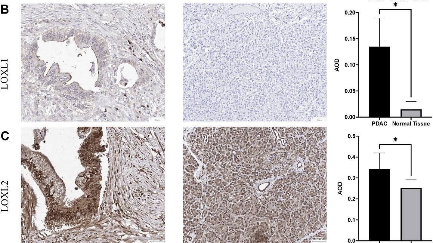 Representative immunohistochemistry of LOXs in PDAC tissues and normal pancreas tissues. (A) IHC staining of LOX and quantification showed higher expression in PDAC than normal pancreas tissues. (B) IHC staining and quantification showed higher expression of LOXL1 in PDAC. (C) IHC staining and quantification showed higher expression of LOXL2 in PDAC. (D) IHC staining and quantification showed lower expression of LOXL3 in PDAC. (E) LOXL4 expression levels were similar in PDAC and normal tissues. *p < 0.01; NS, no significant difference. n = 6, repeated 5 times. Image collected and cropped by CiteAb from the following open publication (//pubmed.ncbi.nlm.nih.gov/35433829), licensed under a CC-BY license. Not internally tested by Novus Biologicals.