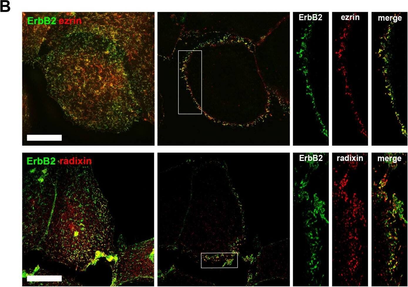 Immunocytochemistry/ Immunofluorescence: Radixin Antibody (1E12) [H00005962-M01] - ERM expression & localization in SKBR3 breast cancer cells(A) Western blot analysis of ERM levels in SKBR3, HeLa & PC3 cells. SKBR3 breast cancer cells do not express moesin. (B) Colocalization of ezrin/radixin & ErbB2 in SKBR3 cells. 3D-SIM of fixed cells, stained for endogenous ERM & ErbB2, shows a high degree of colocalization between the ezrin/radixin & ErbB2 at the plasma membrane (left panel: max. projection; middle: single plane section; right: single channels of insert). Scale bars: 10 μm. (C) Analysis of protein association in SKBR3 cells by proximity ligation assay (PLA). 2 h treatment with 3 μM GA leads to decreased association of ezrin/ErbB2 & radixin/ErbB2. Data is represented as mean +/− SEM (***P < 0.001). (D) Corresponding single plan section of a representative PLA experiment. Fluorescence & DIC pictures of control cells (upper panel) & cell treated for 2 h with geldanamycin (lower panel) are shown. Scale bars: 10 μm. Image collected & cropped by CiteAb from the following publication (//pubmed.ncbi.nlm.nih.gov/27029001), licensed under a CC-BY license. Not internally tested by Novus Biologicals.