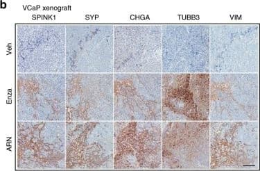 Immunohistochemistry: SPINK1 Antibody (4D4) [H00006690-M01] - ADT induced SPINK1 upregulation associates with NE-phenotype in mice & NEPC patients.a Box plots depicting relative expression of SPINK1, SYP, CHGA, TUBB3, & VIM transcripts (read counts) in VCaP tumors implanted orthotopically in orchiectomized mice & subjected to vehicle (n = 4) or anti-androgens [enzalutamide (n = 4) or ARN-509 (n = 4)] treatment for 4 weeks (GSE95413). b Representative images of immunohistochemical staining for the same markers shown in a using VCaP xenograft tumors as described in a. Scale bar represents 100 μm. c Box plots depicting quantification of the immunohistochemical staining in VCaP xenografts for the markers shown in b. d Representative images for immunohistochemical staining of SPINK1, SYP, CHGA, & TUBB3 in 22RV1 xenograft tumors excised from orchiectomized mice treated with enzalutamide (20 mg/kg body weight) or vehicle control (n = 5 each). Intact group represents non-castrated control mice (n = 5). Scale bar represents 50 μm. e Box plots depicting quantification of the immunohistochemical staining in 22RV1 xenografts for the markers shown in d. f Representative images showing H&E staining (×200 magnification) & immunostaining (×200 magnification) for AR, synaptophysin, & SPINK1 in tumor specimens obtained from NEPC patients’, namely WCM12, WCM155 (an organoid), & WCM677. Scale bar represents 100 µm. Data are presented as box-and-whisker plots with median, where the box extends from 25th–75th percentile, & whiskers ranges from minimum & maximum values. For panels a, c, e one-way ANOVA, Dunnett’s multiple-comparisons test was applied. Image collected & cropped by CiteAb from the following publication (//pubmed.ncbi.nlm.nih.gov/31959826), licensed under a CC-BY license. Not internally tested by Novus Biologicals.