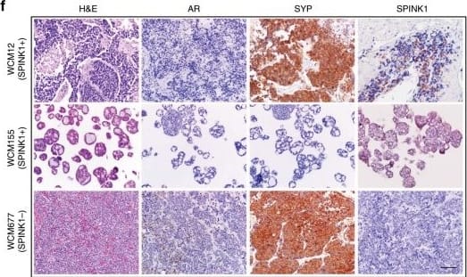 Immunohistochemistry: SPINK1 Antibody (4D4) [H00006690-M01] - ADT induced SPINK1 upregulation associates with NE-phenotype in mice & NEPC patients.a Box plots depicting relative expression of SPINK1, SYP, CHGA, TUBB3, & VIM transcripts (read counts) in VCaP tumors implanted orthotopically in orchiectomized mice & subjected to vehicle (n = 4) or anti-androgens [enzalutamide (n = 4) or ARN-509 (n = 4)] treatment for 4 weeks (GSE95413). b Representative images of immunohistochemical staining for the same markers shown in a using VCaP xenograft tumors as described in a. Scale bar represents 100 μm. c Box plots depicting quantification of the immunohistochemical staining in VCaP xenografts for the markers shown in b. d Representative images for immunohistochemical staining of SPINK1, SYP, CHGA, & TUBB3 in 22RV1 xenograft tumors excised from orchiectomized mice treated with enzalutamide (20 mg/kg body weight) or vehicle control (n = 5 each). Intact group represents non-castrated control mice (n = 5). Scale bar represents 50 μm. e Box plots depicting quantification of the immunohistochemical staining in 22RV1 xenografts for the markers shown in d. f Representative images showing H&E staining (×200 magnification) & immunostaining (×200 magnification) for AR, synaptophysin, & SPINK1 in tumor specimens obtained from NEPC patients’, namely WCM12, WCM155 (an organoid), & WCM677. Scale bar represents 100 µm. Data are presented as box-and-whisker plots with median, where the box extends from 25th–75th percentile, & whiskers ranges from minimum & maximum values. For panels a, c, e one-way ANOVA, Dunnett’s multiple-comparisons test was applied. Image collected & cropped by CiteAb from the following publication (//pubmed.ncbi.nlm.nih.gov/31959826), licensed under a CC-BY license. Not internally tested by Novus Biologicals.