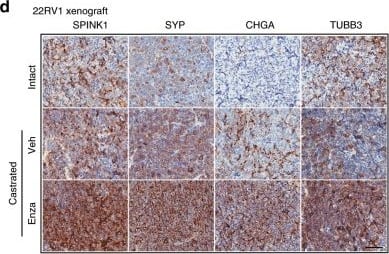 Immunohistochemistry: SPINK1 Antibody (4D4) [H00006690-M01] - ADT induced SPINK1 upregulation associates with NE-phenotype in mice & NEPC patients.a Box plots depicting relative expression of SPINK1, SYP, CHGA, TUBB3, & VIM transcripts (read counts) in VCaP tumors implanted orthotopically in orchiectomized mice & subjected to vehicle (n = 4) or anti-androgens [enzalutamide (n = 4) or ARN-509 (n = 4)] treatment for 4 weeks (GSE95413). b Representative images of immunohistochemical staining for the same markers shown in a using VCaP xenograft tumors as described in a. Scale bar represents 100 μm. c Box plots depicting quantification of the immunohistochemical staining in VCaP xenografts for the markers shown in b. d Representative images for immunohistochemical staining of SPINK1, SYP, CHGA, & TUBB3 in 22RV1 xenograft tumors excised from orchiectomized mice treated with enzalutamide (20 mg/kg body weight) or vehicle control (n = 5 each). Intact group represents non-castrated control mice (n = 5). Scale bar represents 50 μm. e Box plots depicting quantification of the immunohistochemical staining in 22RV1 xenografts for the markers shown in d. f Representative images showing H&E staining (×200 magnification) & immunostaining (×200 magnification) for AR, synaptophysin, & SPINK1 in tumor specimens obtained from NEPC patients’, namely WCM12, WCM155 (an organoid), & WCM677. Scale bar represents 100 µm. Data are presented as box-and-whisker plots with median, where the box extends from 25th–75th percentile, & whiskers ranges from minimum & maximum values. For panels a, c, e one-way ANOVA, Dunnett’s multiple-comparisons test was applied. Image collected & cropped by CiteAb from the following publication (//pubmed.ncbi.nlm.nih.gov/31959826), licensed under a CC-BY license. Not internally tested by Novus Biologicals.