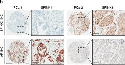 Immunohistochemistry: SPINK1 Antibody (4D4) [H00006690-M01] - SPINK1 is negatively correlated with AR in PCa patients.a Heatmap depicting AR & SPINK1 expression in TCGA-PRAD cohort (n = 180). Shades of yellow & blue represents expression values in log2 (RPM+1). b Representative micrographs depicting PCa tissue microarray (TMA) cores (n = 237), immunostained for SPINK1 & AR expression by immunohistochemistry (IHC). Top panel shows representative IHC for SPINK1 in SPINK1-negative (SPINK1−) & SPINK1-positive (SPINK1+) patients. Bottom panel represents IHC for AR expression in the tumor core from same patients. Scale bar represents 500 µm & 100 µm for the entire core & the inset images, respectively. c Bar plot showing percentage of IHC scoring for AR in the SPINK1+ & SPINK1− patients’ specimens. P-value for the Chi-Square test is indicated. d Contingency table for the AR & SPINK1 status. Patients showing high or medium expression of AR were grouped as AR-(Hi/Med), while patients with low or null AR expression were indicated as AR-(Low/Neg). P-value for Fisher’s exact test is indicated. Image collected & cropped by CiteAb from the following publication (//pubmed.ncbi.nlm.nih.gov/31959826), licensed under a CC-BY license. Not internally tested by Novus Biologicals.