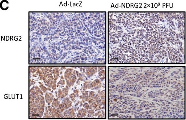 Immunocytochemistry/ Immunofluorescence: NDRG2 Antibody (6A5) [H00057447-M03] - NDRG2 decreases the glucose uptake & GLUT1 protein levels in SK-BR-3-based subcutaneously xenograft tumours. The experiments illustrated are described in the Methods section. (A) Tumour growth was assessed every 3 days until day 21 treatment by measuring two perpendicular diameters & calculating the volume in cubic centimetres. Ad-LacZ, adenovirus expressing LacZ; Ad-NDRG2, adenovirus expressing NDRG2; PFU, Plaque-forming units. The data presented are means ± SD; error bars represent SD from 6 mice. *P < 0.05 & **P < 0.01 versus phosphate-buffered saline (PBS) or Ad-LacZ. (B) Tumour cells were dissociated from xenograft tumours & suspended in PBS after the number of cells was counted. Next, the glucose uptake of cells in each group was detected. The data presented are means ± SD of three independent experiments; error bars represent SD from 6 mice. *P < 0.05 & **P < 0.01 versus PBS or Ad-LacZ. (C) Intratumoural protein expression was assessed by N-myc downstream-regulated gene 2 (NDRG2) & glucose transporter 1 (GLUT1) IHC staining. Representative images are shown. Original magnification: 400 x; Scale bars = 50 μm. (D) Proteins of the xenograft tumours from each group were extracted & analysed by immunoblotting to quantify NDRG2 & GLUT1 protein changes. Image collected & cropped by CiteAb from the following publication (//breast-cancer-research.biomedcentral.com/articles/10.1186/bcr3628), licensed under a CC-BY license. Not internally tested by Novus Biologicals.