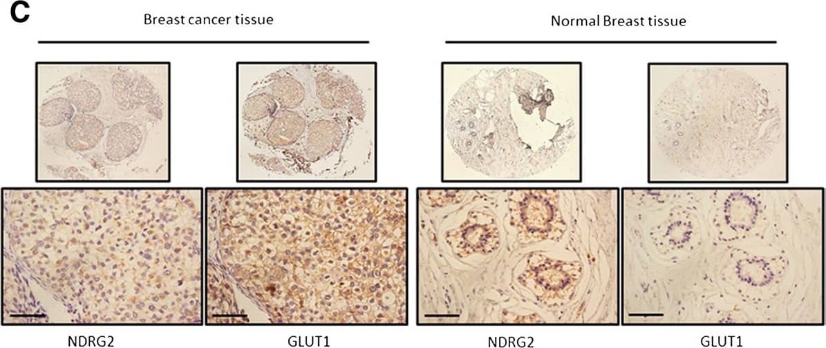 Immunohistochemistry: NDRG2 Antibody (6A5) [H00057447-M03] - NDRG2 is correlated with increased survival & negatively correlated with GLUT1 in breast carcinoma. Kaplan–Meier analysis was carried out according to N-myc downstream-regulated gene 2 (NDRG2) expression levels of disease-free survival (A) & overall survival (B). (C) Serial immunostained sections for NDRG2 & glucose transporter 1 (GLUT1) in breast cancer & normal tissues were analysed. Original magnification, 40× (top) & 400× (bottom); scale bars = 50 μm. (D) Protein was extracted from matched breast tumour tissue (T) & adjacent normal tissue (N) & subjected to immunoblot analysis to examine NDRG2 & GLUT1 expression.  beta -actin served as a loading control. P: patient. Relative expression levels of NDRG2 (E) & GLUT1 (F) in human breast cancer & adjacent normal tissue are shown. immunoreactivity score distribution of cancer & adjacent normal tissue were represented with black & brown closed circles, respectively. The horizontal lines presented are means; error bars represented SD from 30 samples. P < 0.01 was considered a statistically significant difference. Image collected & cropped by CiteAb from the following publication (//breast-cancer-research.biomedcentral.com/articles/10.1186/bcr3628), licensed under a CC-BY license. Not internally tested by Novus Biologicals.