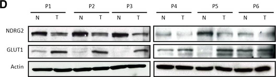 Western Blot: NDRG2 Antibody (6A5) [H00057447-M03] - NDRG2 is correlated with increased survival & negatively correlated with GLUT1 in breast carcinoma. Kaplan–Meier analysis was carried out according to N-myc downstream-regulated gene 2 (NDRG2) expression levels of disease-free survival (A) & overall survival (B). (C) Serial immunostained sections for NDRG2 & glucose transporter 1 (GLUT1) in breast cancer & normal tissues were analysed. Original magnification, 40× (top) & 400× (bottom); scale bars = 50 μm. (D) Protein was extracted from matched breast tumour tissue (T) & adjacent normal tissue (N) & subjected to immunoblot analysis to examine NDRG2 & GLUT1 expression.  beta -actin served as a loading control. P: patient. Relative expression levels of NDRG2 (E) & GLUT1 (F) in human breast cancer & adjacent normal tissue are shown. immunoreactivity score distribution of cancer & adjacent normal tissue were represented with black & brown closed circles, respectively. The horizontal lines presented are means; error bars represented SD from 30 samples. P < 0.01 was considered a statistically significant difference. Image collected & cropped by CiteAb from the following publication (//breast-cancer-research.biomedcentral.com/articles/10.1186/bcr3628), licensed under a CC-BY license. Not internally tested by Novus Biologicals.