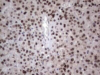 Immunohistochemistry: hHR23b Antibody (OTI7G10) - Azide and BSA Free [NBP2-71269] - Analysis of Carcinoma of Human liver tissue.(Heat-induced epitope retrieval by 1 mM EDTA in 10mM Tris, pH8.5, 120C for 3min)