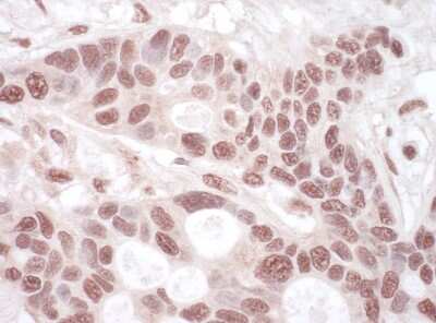 <b>Biological Strategies Validation. </b>Immunohistochemistry-Paraffin: hHpr1-p84-Thoc1 Antibody [NBP1-47304] - FFPE section of human ovarian carcinoma. Antibody: Affinity purified rabbit anti- THOC1 used at a dilution of 1:200 (1ug/ml). Detection: Vector Laboratories ImmPACT NovaRED Peroxidase Substrate