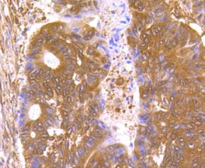 Immunohistochemistry-Paraffin: hHpr1-p84-Thoc1 Antibody (JU53-18) [NBP2-75521] - Analysis of paraffin-embedded human colon cancer tissue using anti-Nuclear Matrix Protein p84 antibody. Counter stained with hematoxylin.