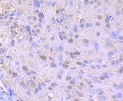 Immunohistochemistry-Paraffin: hHpr1-p84-Thoc1 Antibody (JU53-18) [NBP2-75521] - Analysis of paraffin-embedded human lung cancer tissue using anti-Nuclear Matrix Protein p84 antibody. Counter stained with hematoxylin.