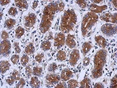 Immunohistochemistry-Paraffin: hUPF1 Antibody [NBP2-16905] - Immunohistochemical analysis of paraffin-embedded Colon ca, using antibody at 1:500 dilution.