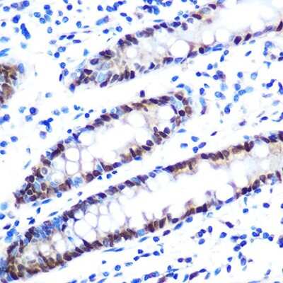 Immunohistochemistry-Paraffin: hnRNP A1 Antibody (10N0F4) [NBP3-15405] - Human colon using hnRNP A1 Rabbit mAb (NBP3-15405) at dilution of 1:100 (40x lens).Perform microwave antigen retrieval with 10 mM PBS buffer pH 7.2 before commencing with IHC staining protocol.