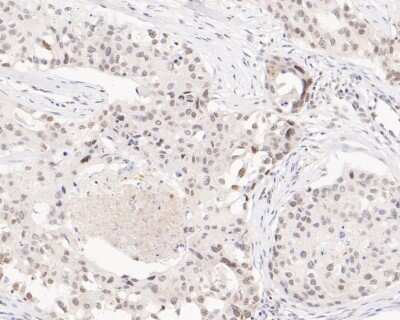 Immunohistochemistry-Paraffin: hnRNP A1 Antibody (JA39-21) [NBP2-66891] - Immunohistochemical analysis of paraffin-embedded human breast carcinoma tissue using anti-hnRNP A1 antibody. The section was pre-treated using heat mediated antigen retrieval with sodium citrate buffer (pH 6.0) for 20 minutes. The tissues were blocked in 5% BSA for 30 minutes at room temperature, washed with ddH2O and PBS, and then probed with the primary antibody (1/200) for 30 minutes at room temperature. The detection was performed using an HRP conjugated compact polymer system. DAB was used as the chromogen. Tissues were counterstained with hematoxylin and mounted with DPX.
