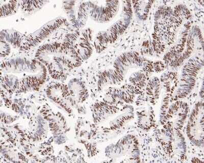 Immunohistochemistry-Paraffin: hnRNP A1 Antibody (JA39-21) [NBP2-66891] - Immunohistochemical analysis of paraffin-embedded human colon carcinoma tissue using anti-hnRNP A1 antibody. The section was pre-treated using heat mediated antigen retrieval with sodium citrate buffer (pH 6.0) for 20 minutes. The tissues were blocked in 5% BSA for 30 minutes at room temperature, washed with ddH2O and PBS, and then probed with the primary antibody (1/200) for 30 minutes at room temperature. The detection was performed using an HRP conjugated compact polymer system. DAB was used as the chromogen. Tissues were counterstained with hematoxylin and mounted with DPX.