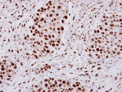 Immunohistochemistry-Paraffin: hnRNP A2B1 Antibody [NBP2-16864] - Immunohistochemical analysis of paraffin-embedded Breast ca, using antibody at 1:250 dilution.