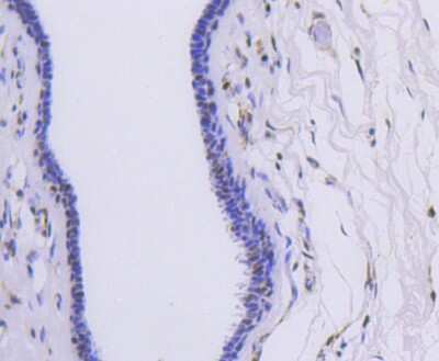 Immunohistochemistry-Paraffin: hnRNP C1 + C2 Antibody (SN0652) [NBP2-67656] - Analysis of paraffin-embedded human breast carcinoma tissue using anti-hnRNP C1+C2 antibody. Counter stained with hematoxylin.