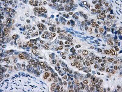 Immunohistochemistry-Paraffin: hnRNP F Antibody (5F5) [NBP2-02221] - Staining of paraffin-embedded Adenocarcinoma of Human ovary tissue using anti-hnRNP F mouse monoclonal antibody.