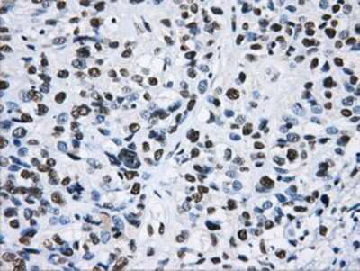 Immunohistochemistry-Paraffin: hnRNP F Antibody (5F5) [NBP2-02221] - Staining of paraffin-embedded Carcinoma of Human bladder tissue using anti-hnRNP F mouse monoclonal antibody.