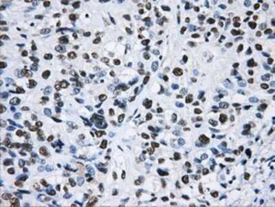 Immunohistochemistry: hnRNP F Antibody (OTI5F5) - Azide and BSA Free [NBP2-70907] - Staining of paraffin-embedded Carcinoma of Human bladder tissue using anti-hnRNP F mouse monoclonal antibody.