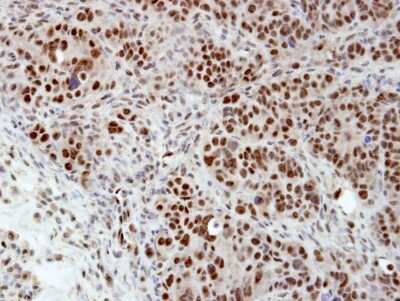 Immunohistochemistry-Paraffin: hnRNP H Antibody [NBP1-31648] - Paraffin-embedded NCIN87 xenograft, using antibody at 1:100 dilution.