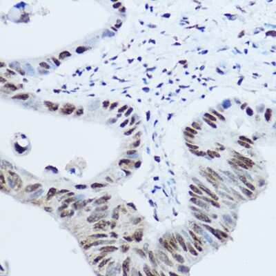 Immunohistochemistry-Paraffin: hnRNP H Antibody [NBP2-93590] - Immunohistochemistry of paraffin-embedded human colon carcinoma using hnRNP H Rabbit pAb (NBP2-93590) at dilution of 1:100 (40x lens). Perform high pressure antigen retrieval with 10 mM citrate buffer pH 6.0 before commencing with IHC staining protocol.