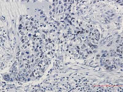 Immunohistochemistry-Paraffin: hnRNP K/J Antibody (S07-5H0) [NBP3-14943] - Immunohistochemistry of hnRNP K/J in paraffin-embedded Human lung cancer tissue using hnRNP K/J Rabbit mAb at dilution 1/50