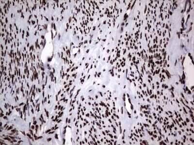 Immunohistochemistry: hnRNP L Antibody (OTI2E4) - Azide and BSA Free [NBP2-70908] - Analysis of Adenocarcinoma of Human endometrium tissue. (Heat-induced epitope retrieval by 1 mM EDTA in 10mM Tris, pH8.5, 120C for 3min)