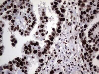 Immunohistochemistry: hnRNP L Antibody (OTI2E4) - Azide and BSA Free [NBP2-70908] - Analysis of Adenocarcinoma of Human ovary tissue. (Heat-induced epitope retrieval by 1 mM EDTA in 10mM Tris, pH8.5, 120C for 3min)