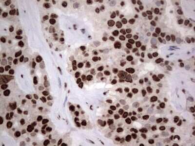 Immunohistochemistry: hnRNP L Antibody (OTI2E4) - Azide and BSA Free [NBP2-70908] - Analysis of Carcinoma of Human liver tissue.(Heat-induced epitope retrieval by 1 mM EDTA in 10mM Tris, pH8.5, 120C for 3min)