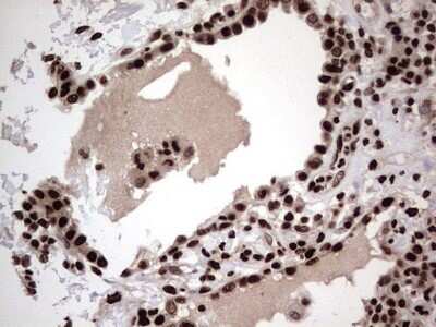 Immunohistochemistry: hnRNP L Antibody (OTI2E4) - Azide and BSA Free [NBP2-70908] - Analysis of Carcinoma of Human lung tissue.(Heat-induced epitope retrieval by 1 mM EDTA in 10mM Tris, pH8.5, 120C for 3min)