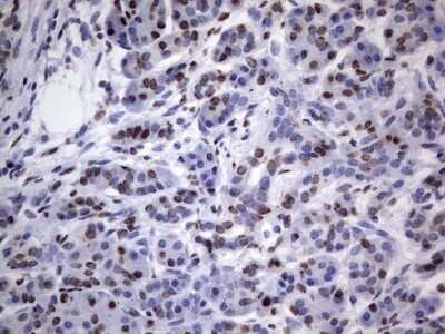 Immunohistochemistry: hnRNP L Antibody (OTI2E4) - Azide and BSA Free [NBP2-70908] - Analysis of Carcinoma of Human pancreas tissue. (Heat-induced epitope retrieval by 1 mM EDTA in 10mM Tris, pH8.5, 120C for 3min)