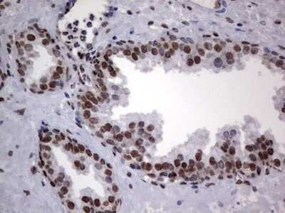 Immunohistochemistry: hnRNP L Antibody (OTI2E4) - Azide and BSA Free [NBP2-70908] - Analysis of Carcinoma of Human prostate tissue. (Heat-induced epitope retrieval by 1 mM EDTA in 10mM Tris, pH8.5, 120C for 3min)