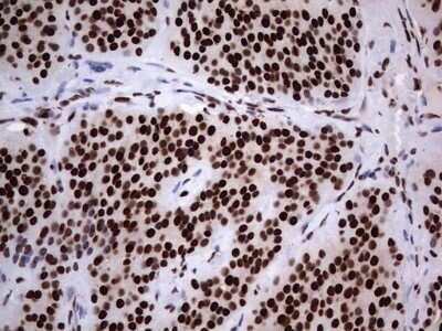 Immunohistochemistry: hnRNP L Antibody (OTI2E4) - Azide and BSA Free [NBP2-70908] - Analysis of Carcinoma of Human thyroid tissue. (Heat-induced epitope retrieval by 1 mM EDTA in 10mM Tris, pH8.5, 120C for 3min)