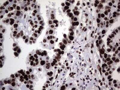 Immunohistochemistry: hnRNP L Antibody (OTI2E4) [NBP2-45990] - Analysis of Adenocarcinoma of Human ovary tissue. (Heat-induced epitope retrieval by 1 mM EDTA in 10mM Tris, pH8.5, 120C for 3min)