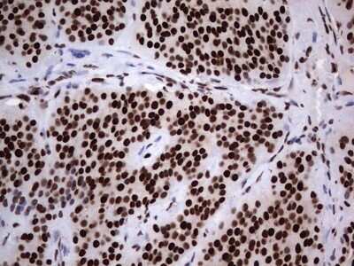 Immunohistochemistry: hnRNP L Antibody (OTI2E4) [NBP2-45990] - Analysis of Carcinoma of Human thyroid tissue. (Heat-induced epitope retrieval by 1 mM EDTA in 10mM Tris, pH8.5, 120C for 3min)