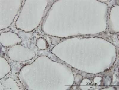 Immunohistochemistry-Paraffin: hnRNP M Antibody (3F7) [H00004670-M03] - Analysis of monoclonal antibody to HNRPM on formalin-fixed paraffin-embedded human thyroid nodular goiter. Antibody concentration 3 ug/ml