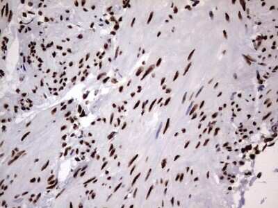 Immunohistochemistry: hnRNP M Antibody (4C9) [NBP2-45991] - Analysis of Carcinoma of Human kidney tissue. (Heat-induced epitope retrieval by 1 mM EDTA in 10mM Tris, pH8.5, 120C for 3min)