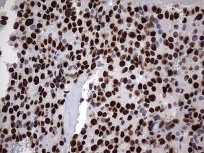 Immunohistochemistry: hnRNP M Antibody (OTI4C9) - Azide and BSA Free [NBP2-71200] - Analysis of Adenocarcinoma of Human breast tissue. (Heat-induced epitope retrieval by 1 mM EDTA in 10mM Tris, pH8.5, 120C for 3min)