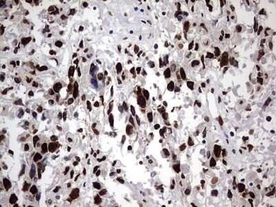 Immunohistochemistry: hnRNP M Antibody (OTI4C9) - Azide and BSA Free [NBP2-71200] - Analysis of Adenocarcinoma of Human ovary tissue. (Heat-induced epitope retrieval by 1 mM EDTA in 10mM Tris, pH8.5, 120C for 3min)